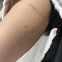 二の腕に…な、なんじゃこりゃ〜