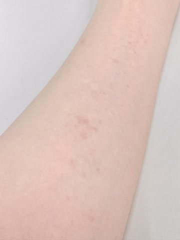 スパンキング跡