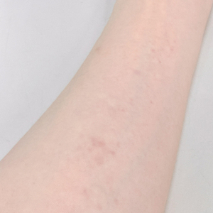 スパンキング跡