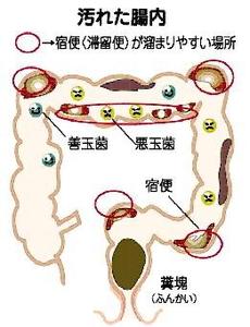 セルフ腸内洗浄