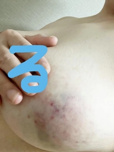 いたいのいたいのとんでいけ